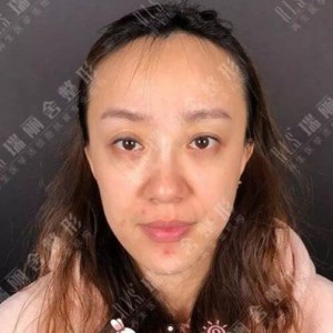 瑞麗舍整形馬君做的全臉自體脂肪填充，不錯呢~