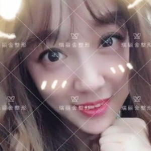 瑞麗舍整形馬君做的全臉自體脂肪填充，不錯呢~