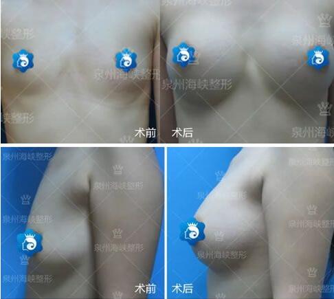 黃惠銘假體隆胸案例