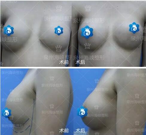 黃惠銘隆胸失敗修復(fù)案例