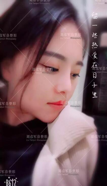 劉彥君隆鼻案例圖恢復(fù)記錄