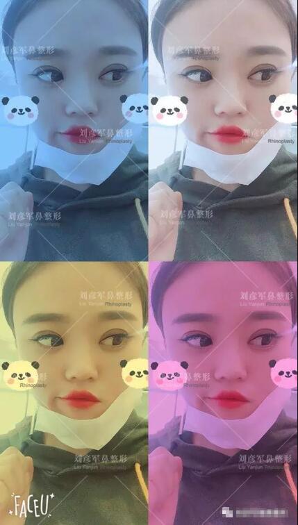 劉彥君隆鼻案例圖恢復(fù)記錄