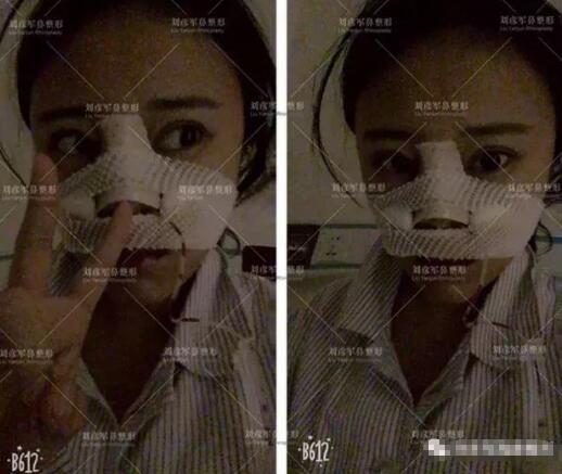 劉彥君隆鼻案例圖恢復(fù)記錄