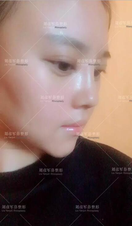 劉彥君隆鼻案例圖恢復(fù)記錄