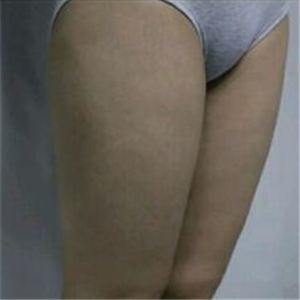 去找東方和諧馮斌做了大腿抽脂，分享一下果吧！