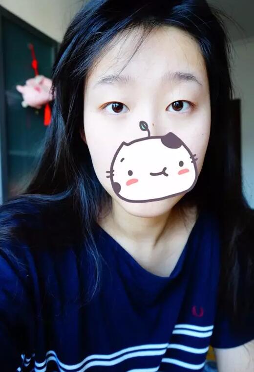 張毅整形醫(yī)生雙眼皮圖分享日記手札