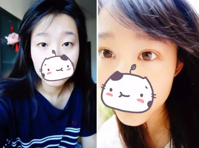 張毅整形醫(yī)生雙眼皮圖分享日記手札