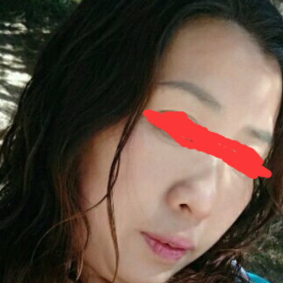 北京邦定張亞昆做的面部提升，果較為不錯(cuò)~