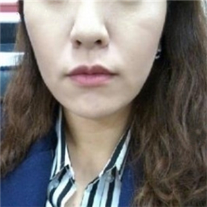 北京南加安棟顯給我做的自體脂肪去法令紋，果很好~