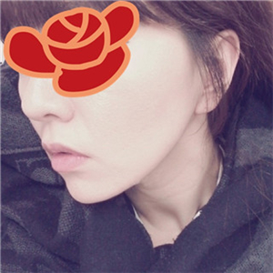 北京南加安棟顯給我做的自體脂肪去法令紋，果很好~