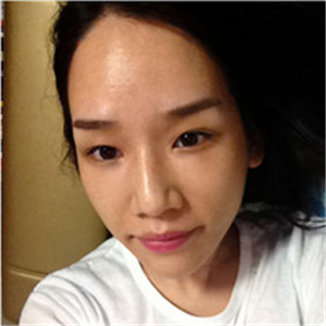 北京南加高紅霞醫(yī)生做的頭發(fā)種植，恢復(fù)得很好~