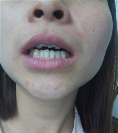 成都圣貝口腔翟永森做的牙齒矯正，分享果照片~