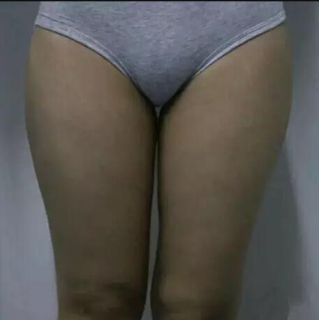 哈醫(yī)大二院整形科徐學武大腿吸脂術前后恢復分享手記