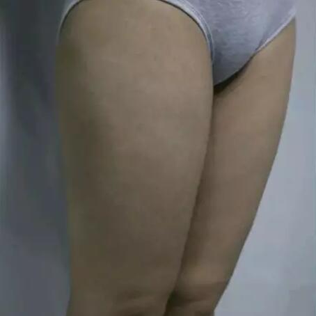 哈醫(yī)大二院整形科徐學武大腿吸脂術前后恢復分享手記