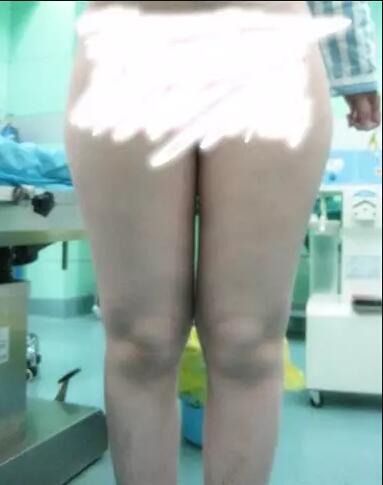 哈醫(yī)大二院整形科徐學武大腿吸脂術前后恢復分享手記