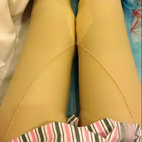 哈醫(yī)大二院整形科徐學武大腿吸脂術前后恢復分享手記