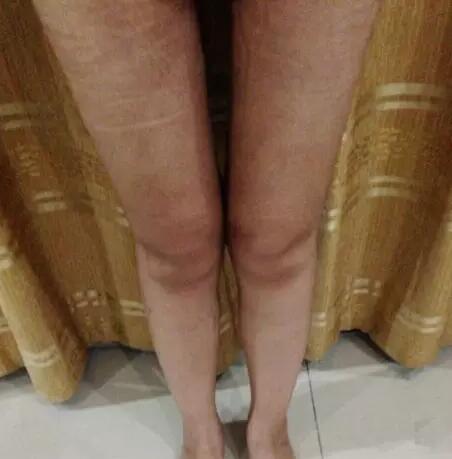 哈醫(yī)大二院整形科徐學武大腿吸脂術前后恢復分享手記