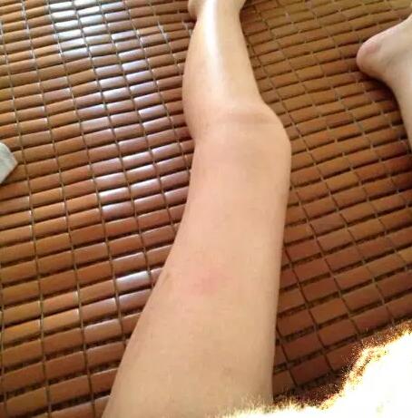 哈醫(yī)大二院整形科徐學武大腿吸脂術前后恢復分享手記