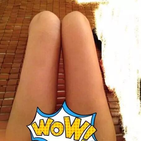 哈醫(yī)大二院整形科徐學武大腿吸脂術前后恢復分享手記