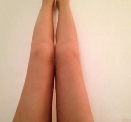 哈醫(yī)大二院整形科徐學武大腿吸脂術前后恢復分享手記