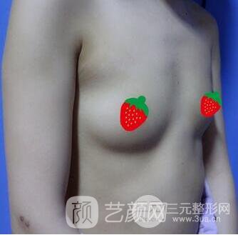 北京伊美爾何禎平假體豐胸照片四個月恢復手記