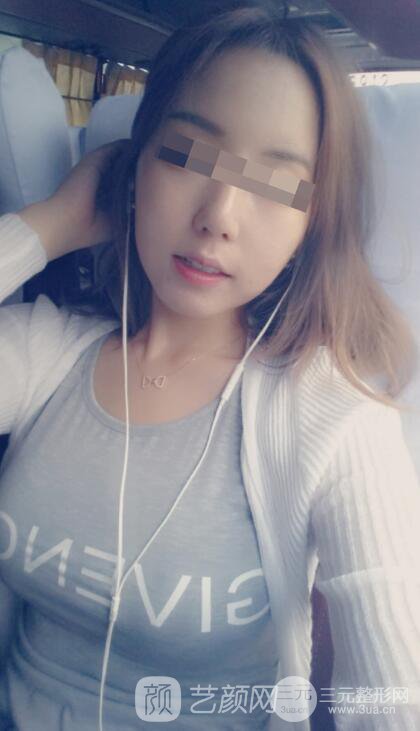 北京隆胸抽脂多少錢?北京東方和諧自體脂肪豐胸案例