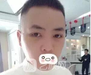 愛思特張姣姣雙眼皮案例照片日記 男生也會做雙眼皮手術哦