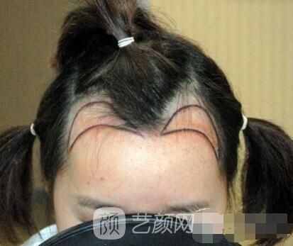 重慶西南醫(yī)院王量植發(fā)照片