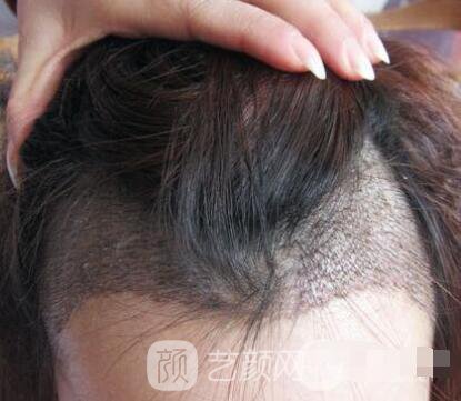 重慶西南醫(yī)院王量植發(fā)照片