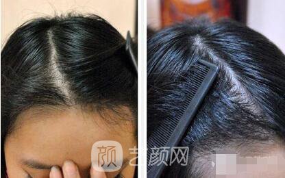 重慶西南醫(yī)院王量植發(fā)照片