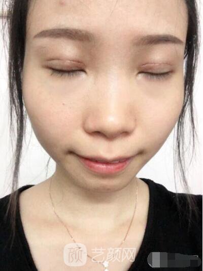 莊璐全切雙眼皮照 全過程恢復(fù)經(jīng)驗(yàn)之談