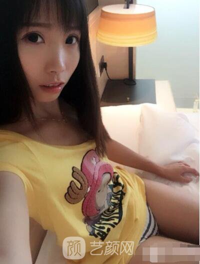 莊璐全切雙眼皮照 全過程恢復(fù)經(jīng)驗(yàn)之談