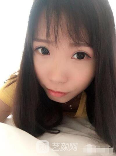 莊璐全切雙眼皮照 全過程恢復(fù)經(jīng)驗(yàn)之談