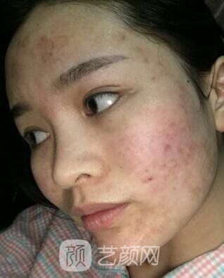 福州比華利林秋蓉激光祛痘圖 滿臉痘痘到光滑肌膚