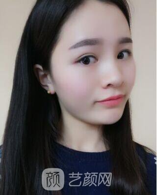 福州比華利林秋蓉激光祛痘圖 滿臉痘痘到光滑肌膚