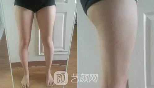 東莞締美陳星光大腿吸脂照片 內(nèi)附全部恢復(fù)過程體驗