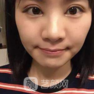 西安碑林西美王艷娜雙眼皮圖 真實案例心情分享