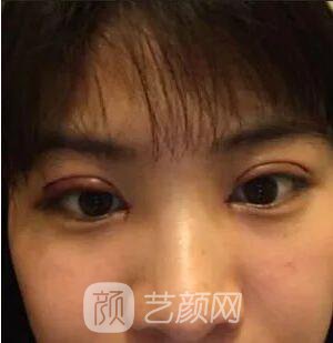 西安碑林西美王艷娜雙眼皮圖 真實案例心情分享