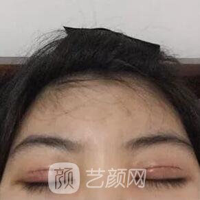 西安碑林西美王艷娜雙眼皮圖 真實案例心情分享