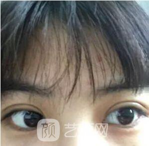 西安碑林西美王艷娜雙眼皮圖 真實案例心情分享