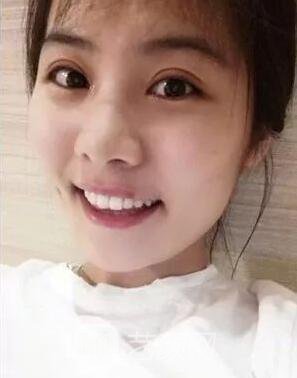 西安碑林西美王艷娜雙眼皮圖 真實案例心情分享