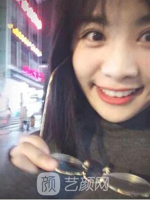 西安碑林西美王艷娜雙眼皮圖 真實案例心情分享