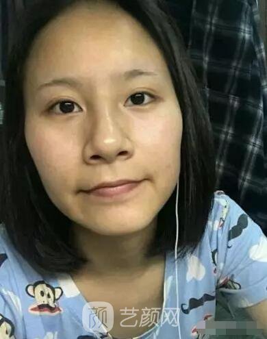 北京上上相鄭楚蓉院長(zhǎng)自體脂肪填充全臉圖心情小記