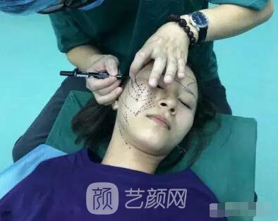 北京上上相鄭楚蓉院長(zhǎng)自體脂肪填充全臉圖心情小記