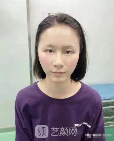 北京上上相鄭楚蓉院長(zhǎng)自體脂肪填充全臉圖心情小記