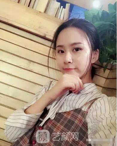 北京上上相鄭楚蓉院長(zhǎng)自體脂肪填充全臉圖心情小記