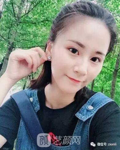 北京上上相鄭楚蓉院長(zhǎng)自體脂肪填充全臉圖心情小記