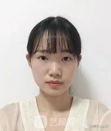 王紅敏切開雙眼皮+開內(nèi)眼角圖術后心情小述