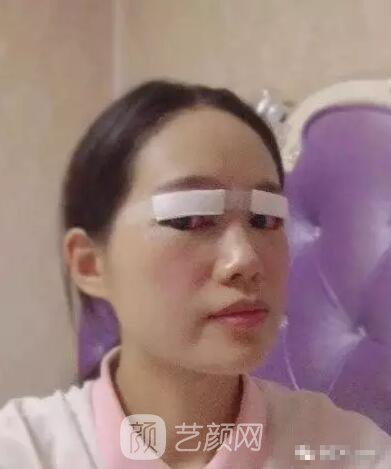王紅敏切開雙眼皮+開內(nèi)眼角圖術后心情小述