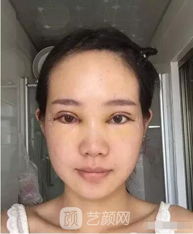 王紅敏切開雙眼皮+開內(nèi)眼角圖術后心情小述